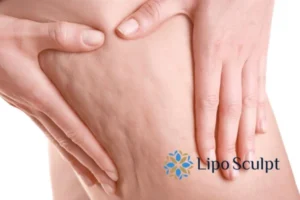 CoolSculpting for Legs: The Innovative Approach to Redefining Your Legs 5 Start your journey today book your coolsculpting treatment Southsea online today!
