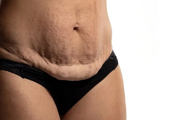 Lost the Weight but Not the Loose Skin? 1 image of womans stomach after weight loss showing loose skin Southsea